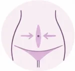diástasis abdominal